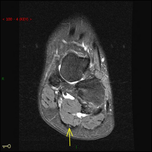 Figure 6 for case Juvenile plantar fibromatosis